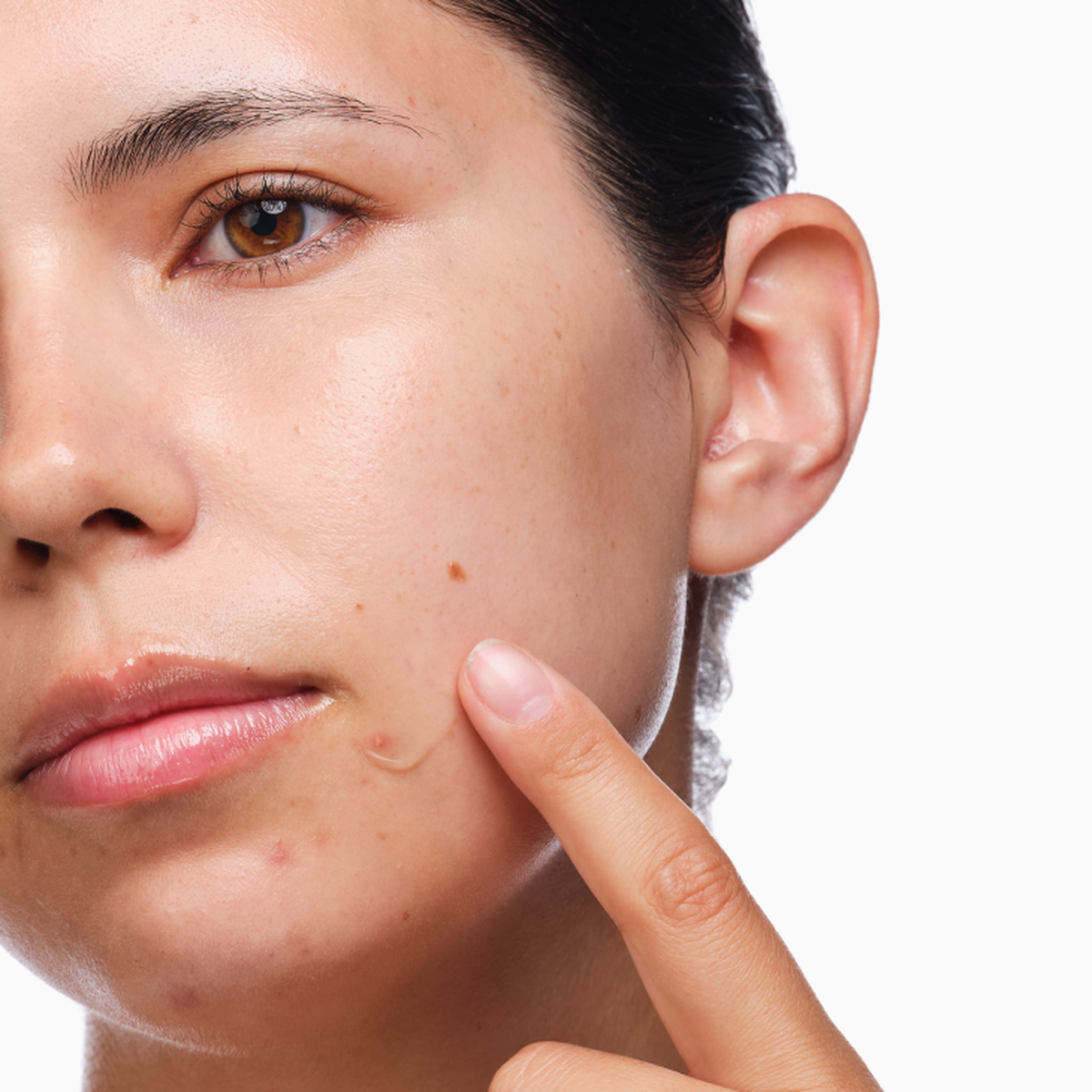 the-acne-set-c7 rdn-the-acne-set-application.png