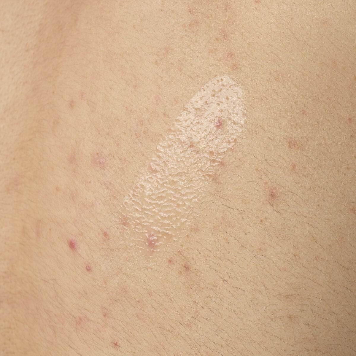 salicylic-acid-0-5-body-serum-o0 ORD-salicylic-acid-05-body-240ml-application.jpg