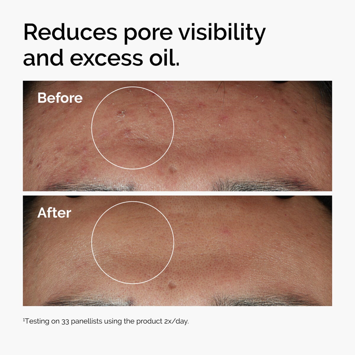 niacinamide-10-zinc-1-s9 ord-niacinamide-zinc-blemish-serum-before-after-pores.jpg
