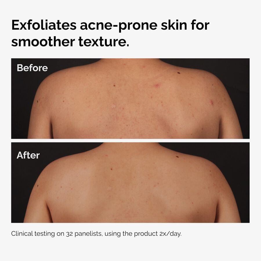 the-body-care-collection-d3 ord-salicylic-acid-body-serum-before-after-graphic-NA.jpg